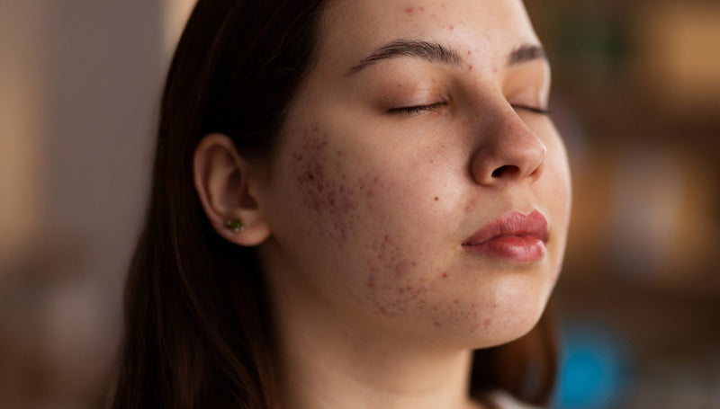 Sunscreen and Breakouts: Is Your Sunscreen Causing Acne?