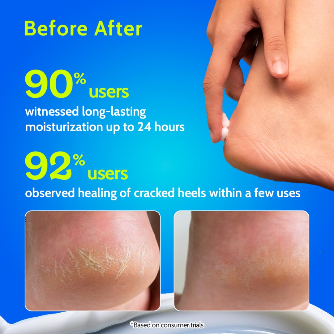 10% Urea Foot Cream for Cracked Heels & Diabetic Foot