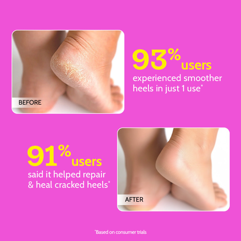 20% Urea Hydrating Foot Roll-On for Cracked Heels & Diabetic Foot - 50 gm | Pack of 2