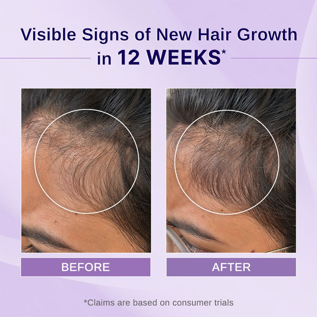 Rosemary & Hibiscus Hair Growth Oil With Redensyl, Biotin, Bhringraj & Aloe Vera - 100 ml