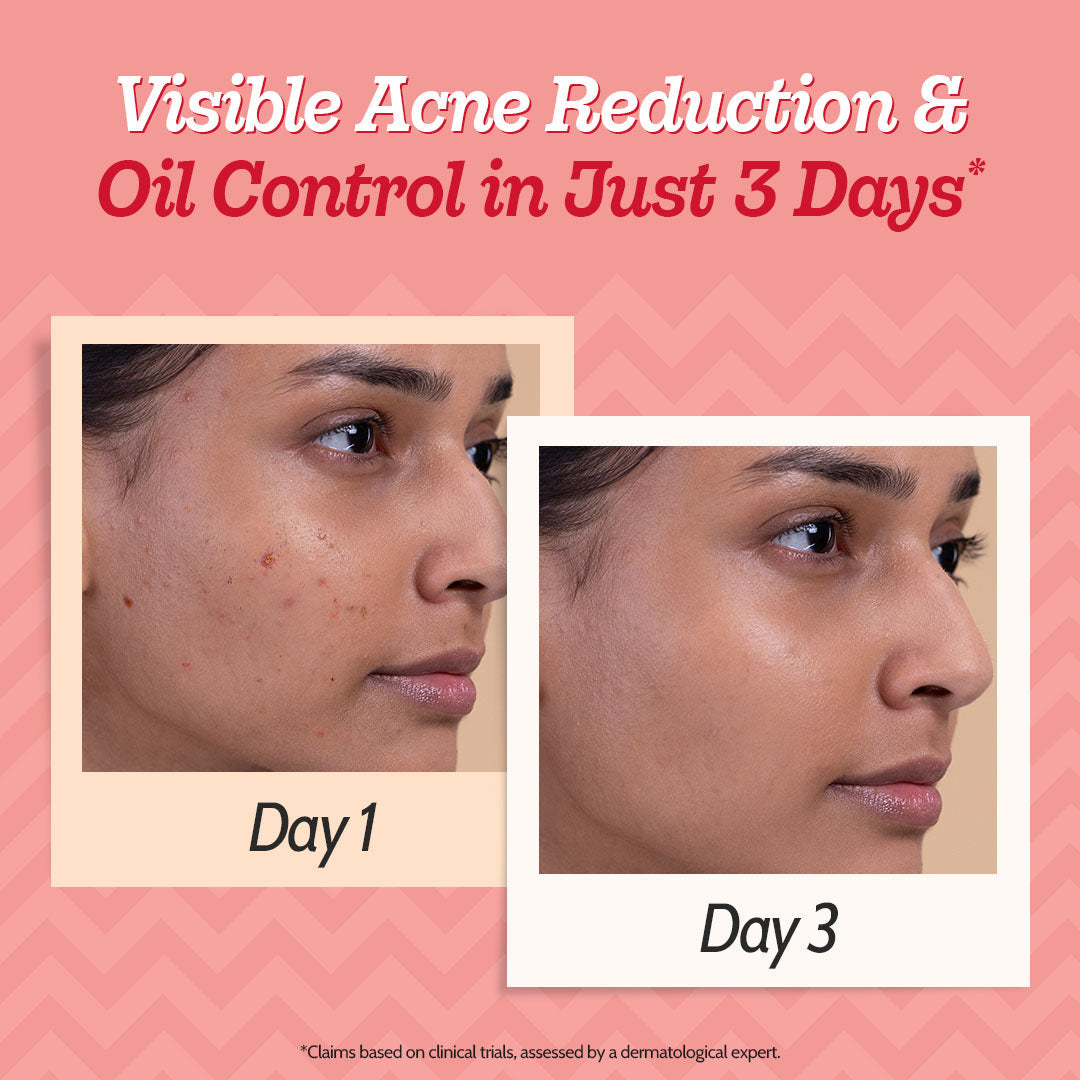 2% Salicylic Acid Face Serum With Lactic Acid For Acne Control - 10 ml