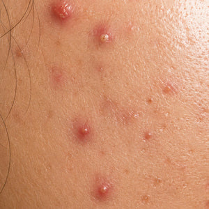 Acne image