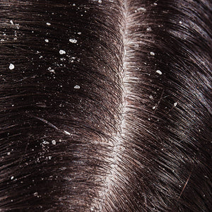 Dandruff image