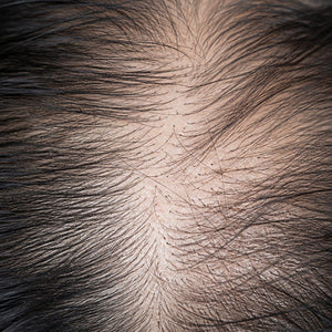Hair Fall image