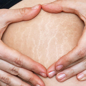 Stretchmarks image