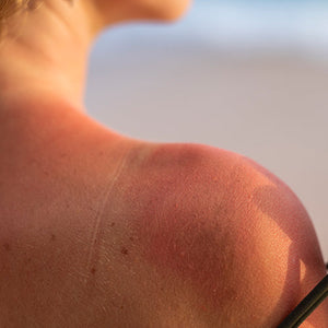 Sun Damage image